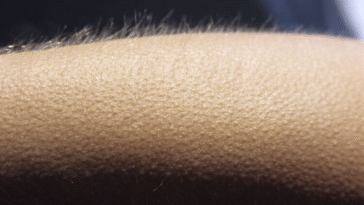 What Causes Goosebumps, And Why