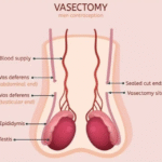 Vasectomy: Key Facts and Benefits for Men
