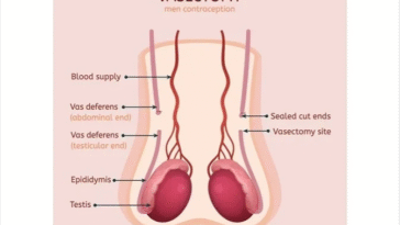 Vasectomy: Key Facts and Benefits for Men