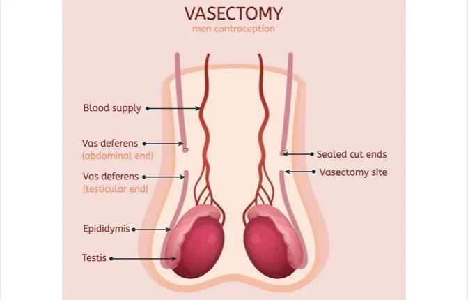 Vasectomy: Key Facts and Benefits for Men