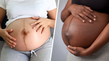 Why Do Black Lines Appear On Pregnant Women’s Stomachs, And What Do They Do