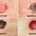 Effect And All You Need To Know About Skin Cancer