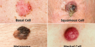 Effect And All You Need To Know About Skin Cancer