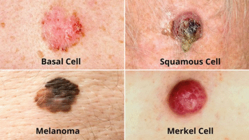 Effect And All You Need To Know About Skin Cancer