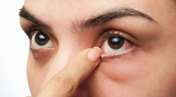 8 Tips On How To Improve The Look Of Your Under-eyes